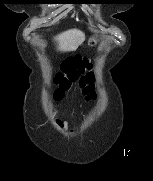 Calcified adrenal glands and Spigelian hernia (Radiopaedia 49741-54988 B 13).jpg