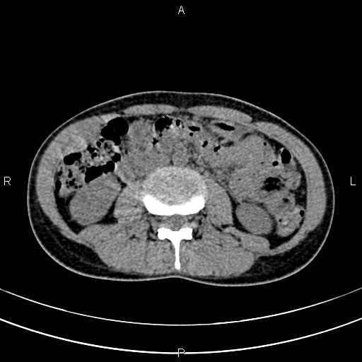 File:Calcified hepatic hydatid cyst (Radiopaedia 83870-99072 Axial non-contrast 91).jpg