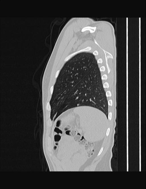 Calcifying pulmonary metastases (Radiopaedia 33359-34396 Sagittal lung window 12).jpg