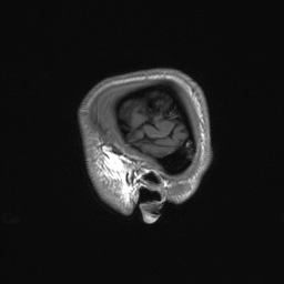 Callosal dysgenesis with interhemispheric cyst (Radiopaedia 53355-59335 Sagittal T1 163).jpg