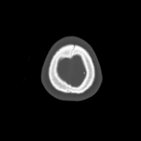 Calvarial osteoma (Radiopaedia 36520-38079 Axial bone window 104).jpg