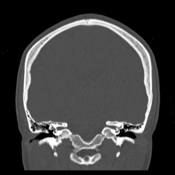 Calvarial osteoma (Radiopaedia 36520-38079 C 54).jpg