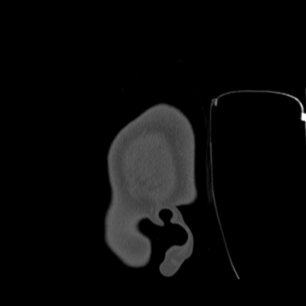 Calvarial osteoma (Radiopaedia 36520-38079 Sagittal bone window 4).jpg