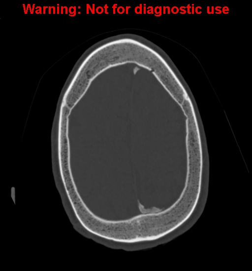 Calvarial thickening from chronic shunting (Radiopaedia 60079-67637 Axial bone window 144).jpg