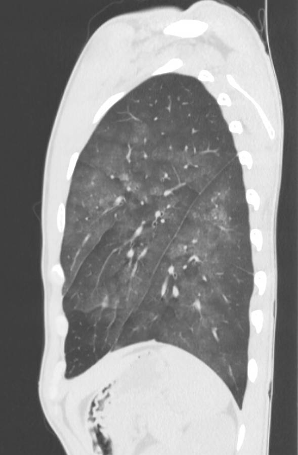 Cannabis-induced diffuse alveolar hemorrhage (Radiopaedia 89834-106946 Sagittal lung window 111).jpg