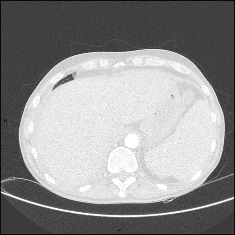 Cannonball metastases (Radiopaedia 82110-96150 Axial lung window 172).jpg