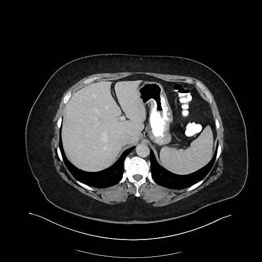 Carcinoid tumor - terminal ileum (Radiopaedia 60931-68739 A 27).jpg