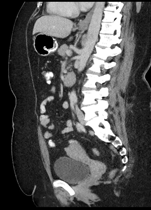 Carcinoid tumor - terminal ileum (Radiopaedia 60931-68739 C 43).jpg
