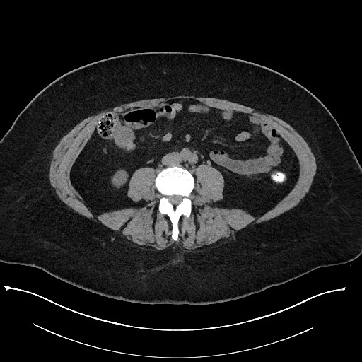 Carcinoid tumor - terminal ileum (Radiopaedia 60931-68740 Axial non-contrast 66).jpg