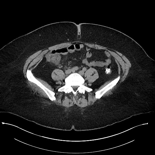 Carcinoid tumor - terminal ileum (Radiopaedia 60931-68740 Axial non-contrast 78).jpg