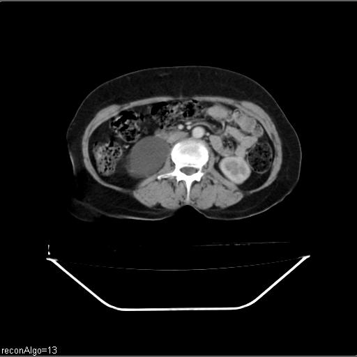 Carcinoma cervix- recurrence (Radiopaedia 34702-36137 B 25).jpg