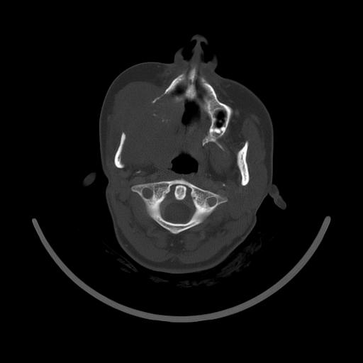 Carcinoma of the maxillary antrum (Radiopaedia 53805-59888 Axial bone window 66).jpg