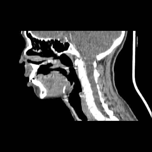 Carcinoma of the maxillary antrum (Radiopaedia 53805-59888 Sagittal C+ delayed 96).jpg