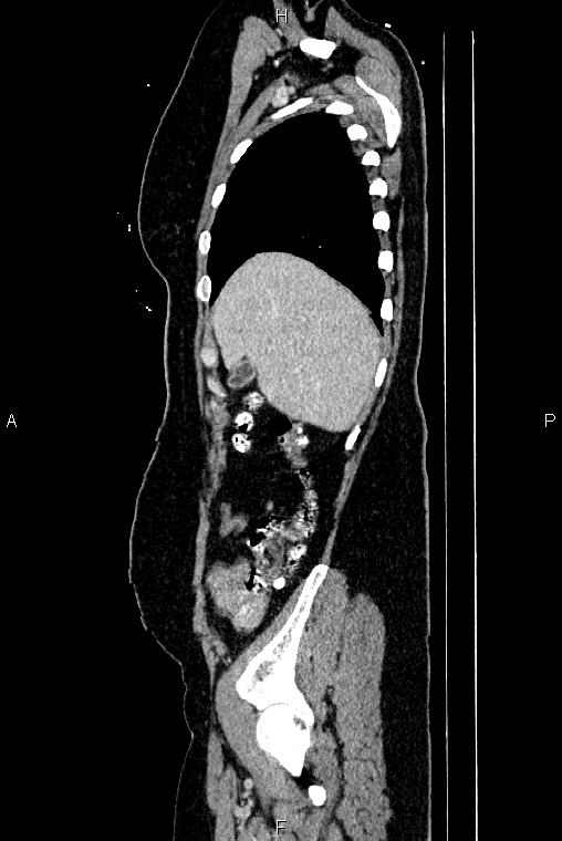 Carcinoma of uterine cervix (Radiopaedia 85861-101700 D 10).jpg