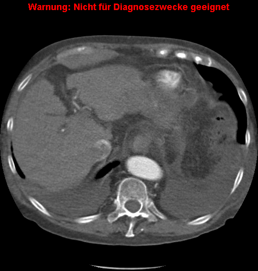 File:Cardiac perforation following transcatheter aortic valve implantation (Radiopaedia 23714-23863 A 18).png