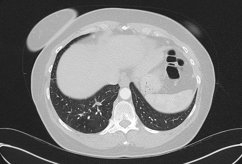 Cardiac sarcoidosis (Radiopaedia 74548-85534 Axial lung window 75).jpg