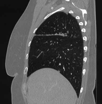 Cardiac sarcoidosis (Radiopaedia 74548-85534 Sagittal lung window 74).jpg