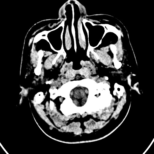 Cardioembolic stroke- ACA and MCA territories (Radiopaedia 58904-66140 Axial non-contrast 33).jpg