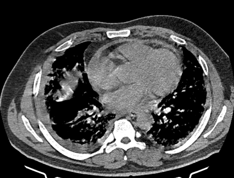 Cardiogenic pulmonary edema (Radiopaedia 68180-77678 Axial non-contrast 30).jpg