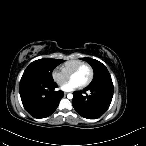 Caroli disease with medullary sponge kidney (Radiopaedia 82622-96804 C 3).jpg