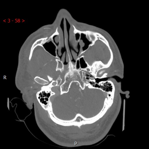 Caroticocavernous fistula (Radiopaedia 42346-45457 A 16).jpg