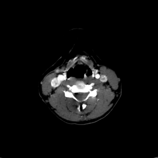 File:Carotid body tumor (Radiopaedia 39845-42300 B 21).jpg