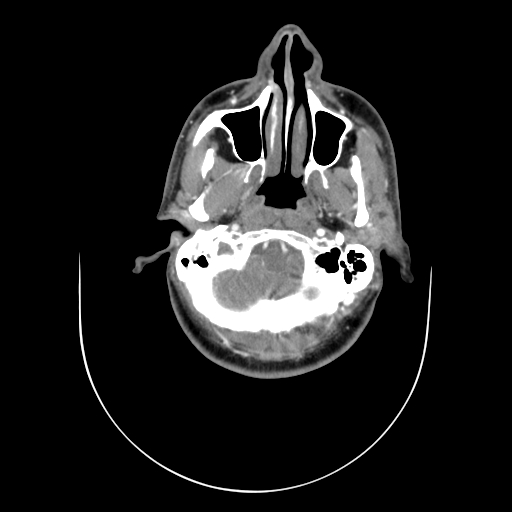 File:Carotid bulb pseudoaneurysm (Radiopaedia 57670-64616 A 4).jpg