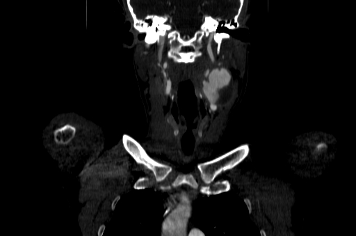 File:Carotid bulb pseudoaneurysm (Radiopaedia 57670-64616 D 18).jpg