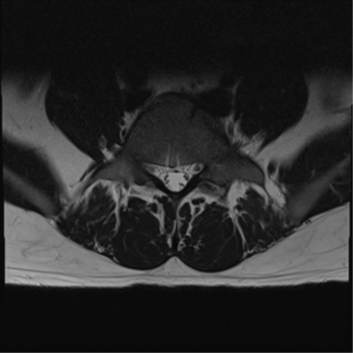 File:Cauda equina syndrome (Radiopaedia 53615-59672 Axial T2 10).png