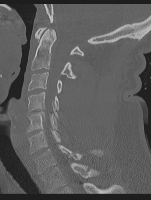 Cavernoma of cervical cord (Radiopaedia 50838-56346 Sagittal bone window 39).png