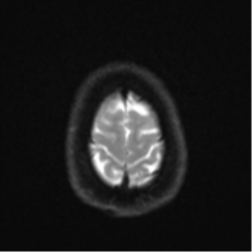 File:Cavernoma with bleed - midbrain (Radiopaedia 54546-60774 Axial DWI 25).png