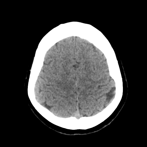 Cavernoma with hemorrhage (Radiopaedia 70755-80931 Axial non-contrast 42).png