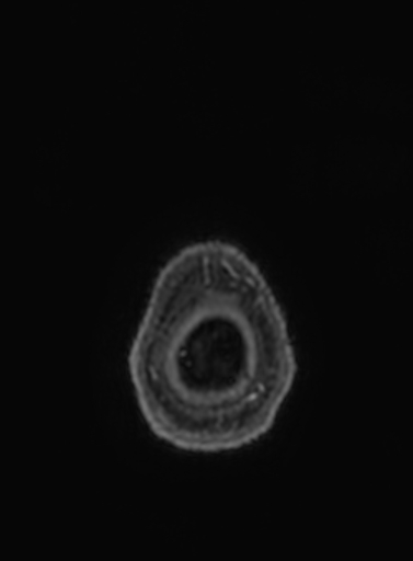 Cavernous hemangioma of the cerebellar falx (Radiopaedia 73025-83724 Axial T1 C+ 5).jpg