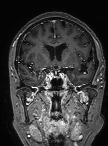 Cavernous hemangioma of the cerebellar falx (Radiopaedia 73025-83724 Coronal T1 C+ 155).jpg