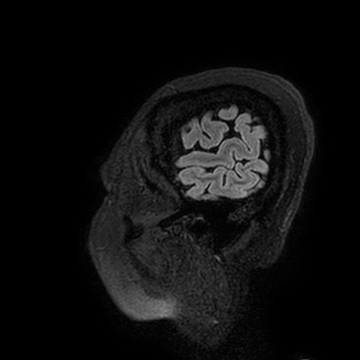 Cavernous hemangioma of the cerebellar falx (Radiopaedia 73025-83724 Sagittal FLAIR 207).jpg