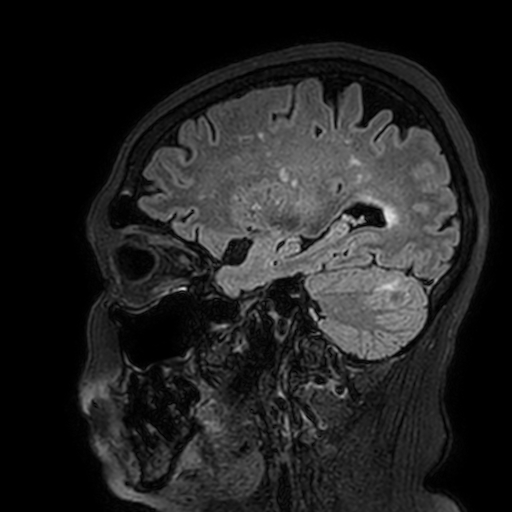 File:Cavernous hemangioma of the cerebellar falx (Radiopaedia 73025-83724 Sagittal FLAIR 61).jpg
