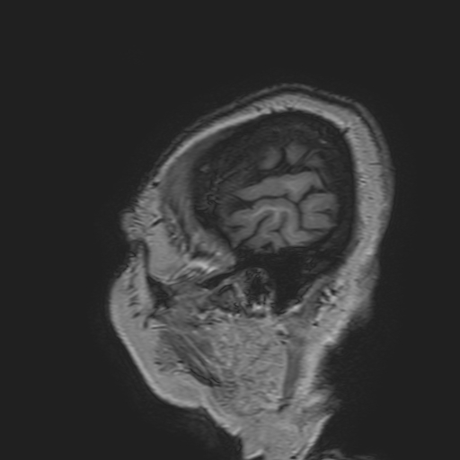 File:Cavernous hemangioma of the cerebellar falx (Radiopaedia 73025-83724 Sagittal T1 19).jpg