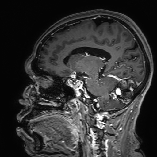 File:Cavernous hemangioma of the cerebellar falx (Radiopaedia 73025-83724 Sagittal T1 C+ 125).jpg