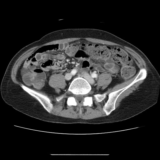 File:Cavernous hepatic hemangioma (Radiopaedia 75441-86667 B 78).jpg