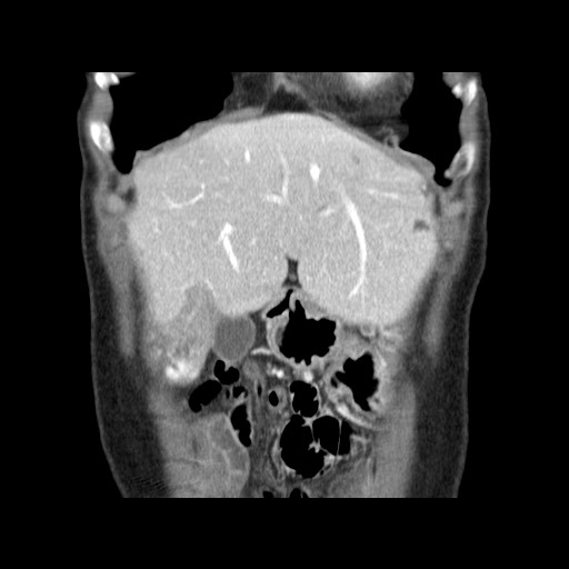 Cavernous hepatic hemangioma (Radiopaedia 75441-86667 C 31).jpg