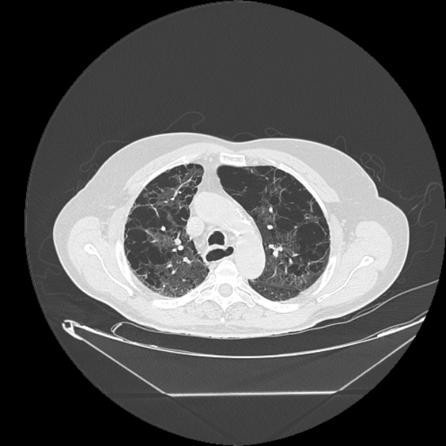 Cavitating bronchogenic carcinoma (Radiopaedia 44489-48162 Axial lung window 24).jpg