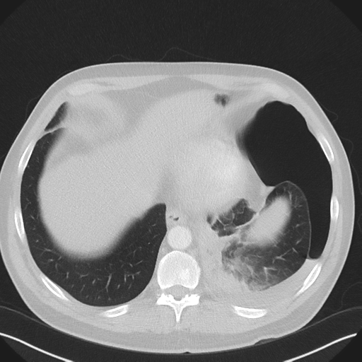 Cavitating pneumonia complicated by pneumothorax (Radiopaedia 48149-52994 Axial lung window 53).png