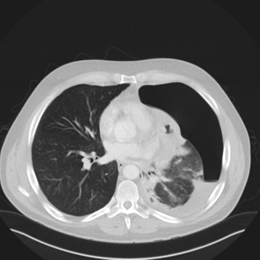 Cavitating pneumonia complicated by pneumothorax (Radiopaedia 48149-52994 Coronal lung window 1).png
