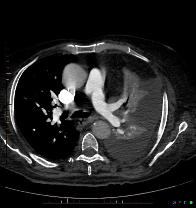 Cavitating pulmonary infarction (Radiopaedia 54634-60849 Axial C+ CTPA 31).jpg