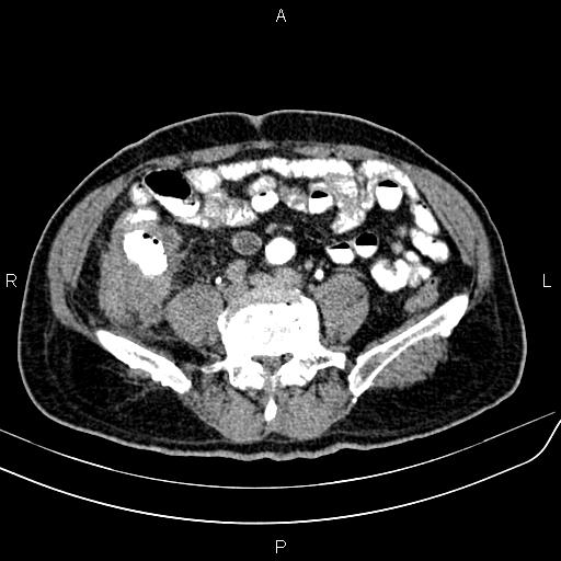 File:Cecal cancer with appendiceal mucocele (Radiopaedia 91080-108651 Axial C+ delayed 49).jpg