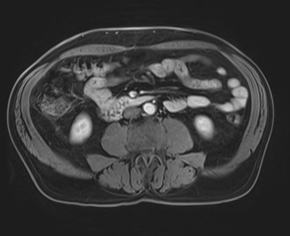 Cecal mass causing appendicitis (Radiopaedia 59207-66532 H 77).jpg