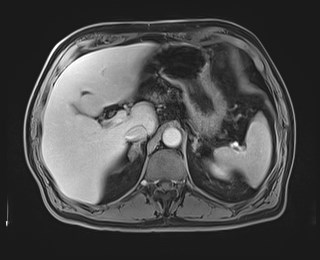 Cecal mass causing appendicitis (Radiopaedia 59207-66532 J 40).jpg