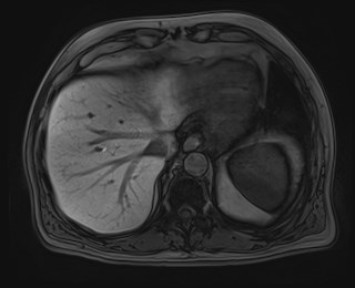Cecal mass causing appendicitis (Radiopaedia 59207-66532 K 25).jpg