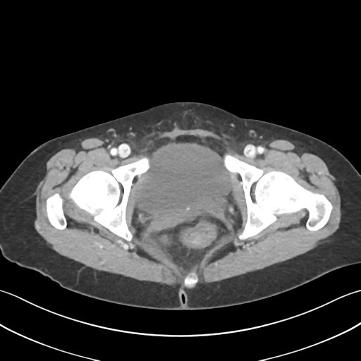 Cecum hernia through the foramen of Winslow (Radiopaedia 46634-51112 A 71).png