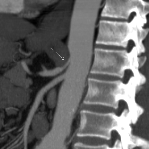 File:Celiac artery compression by the diaphragmatic crurae (Radiopaedia 31739-32667 Sagittal CTA 1).jpg